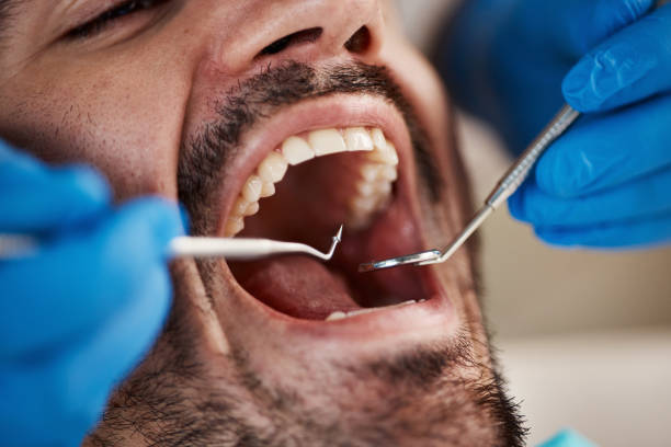 Best Emergency Dental Care for Broken or Chipped Teeth in Sunset, FL