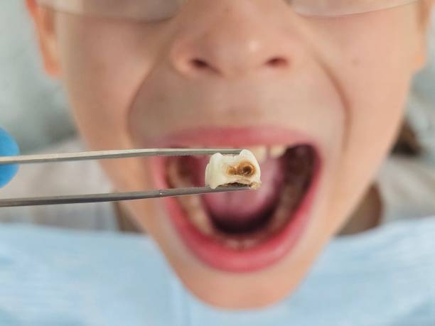 Best Emergency Tooth Extraction in Sunset, FL